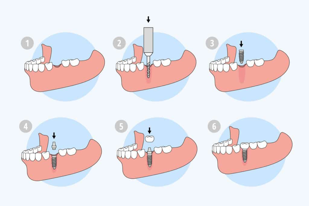 種牙的流程