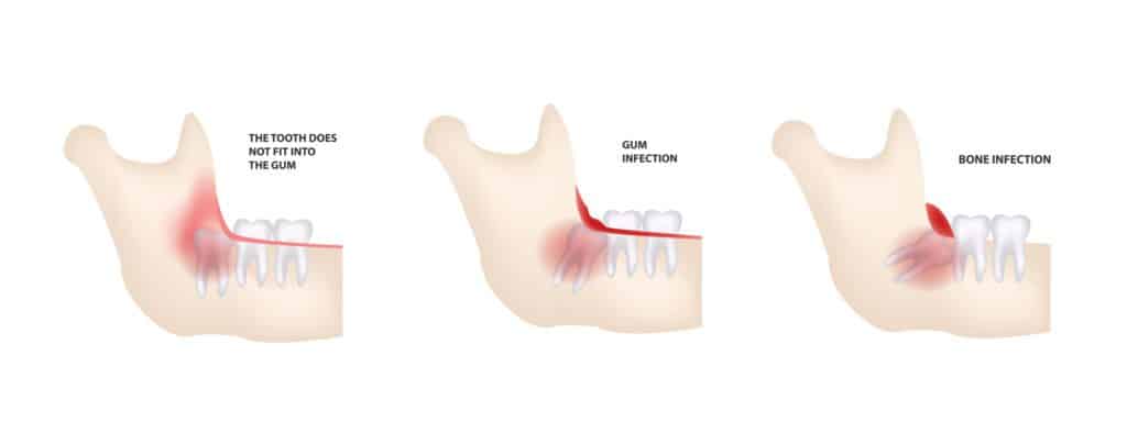 智慧齒所引起的問題