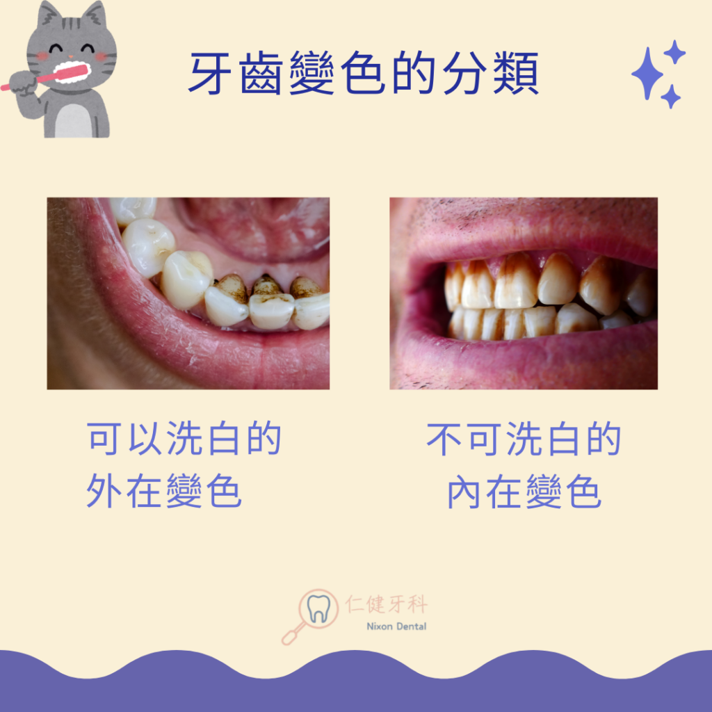 牙齒變色的分類